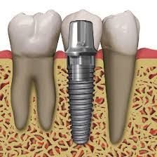 IMPLANTOLOGY IMPLANTOLOGIA