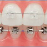 ORTHODONTICS ORTODONCIA brackets