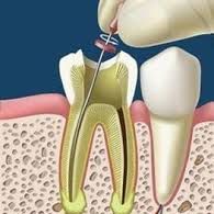 ROOT CANAL TRATAMIENTO DE CONDUCTOS